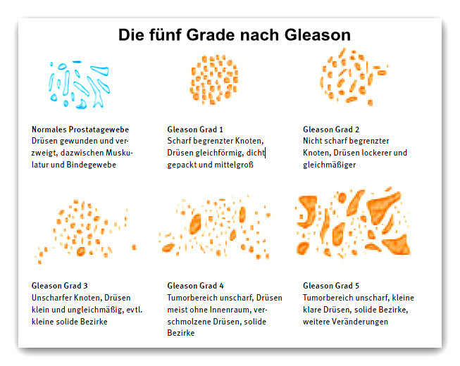 Gleason Grade